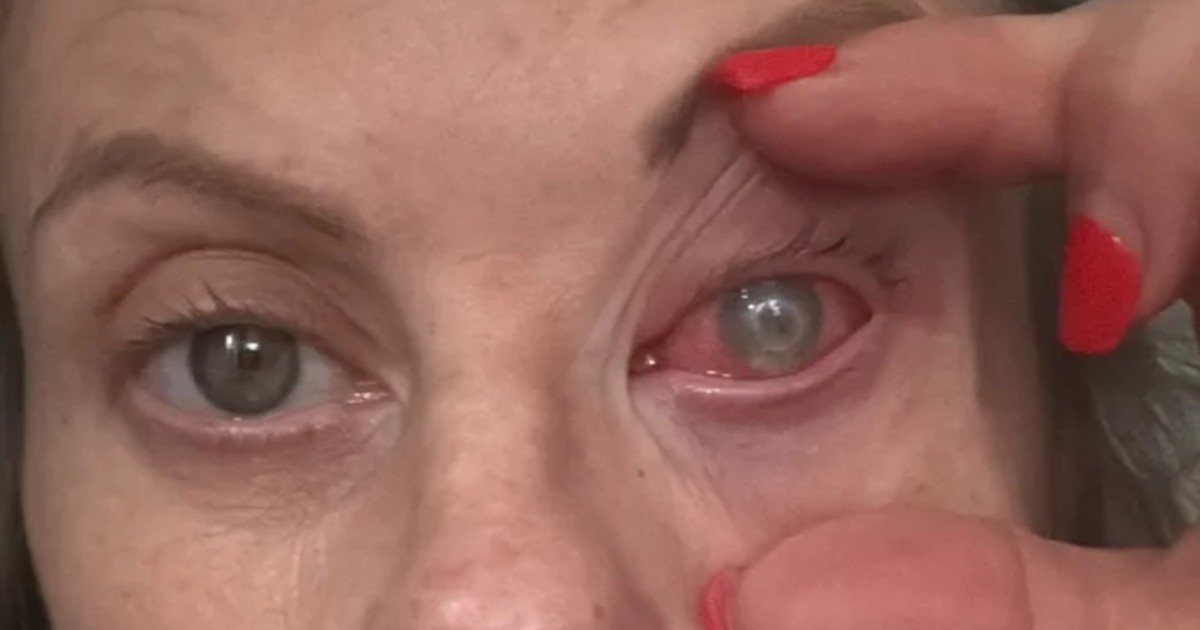 Rara infección ocular amenaza con dejar ciega a una mujer: el parásito 'devora' la córnea