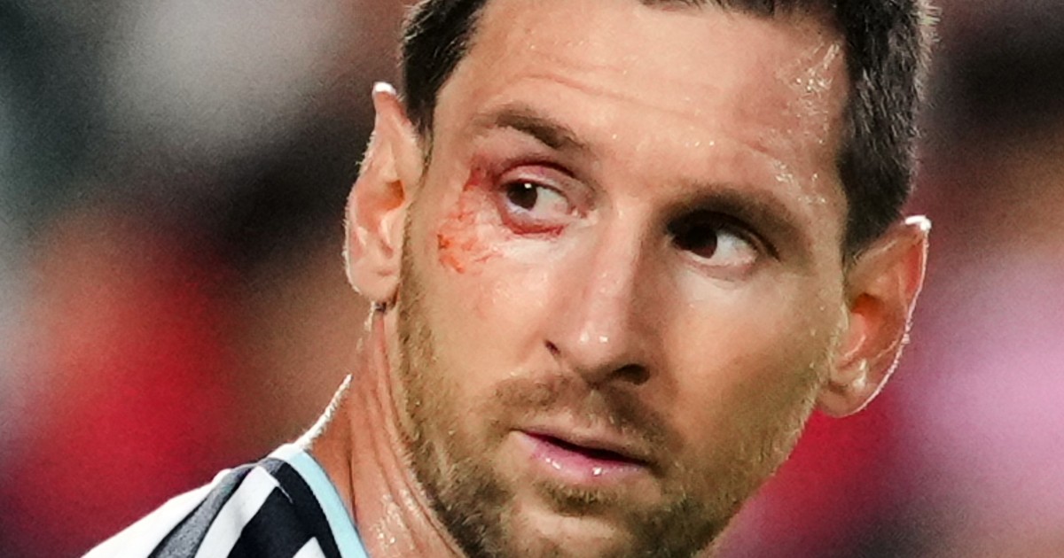 Messi recibió atención médica en el ojo durante Argentina vs Suiza