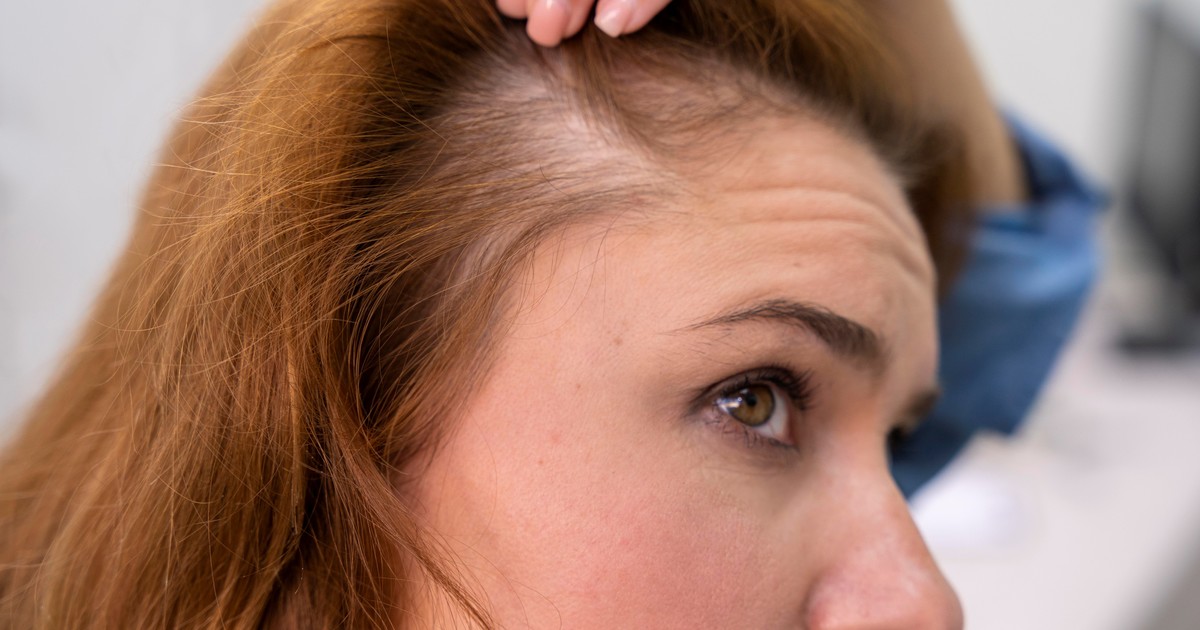 Jóvenes en alerta: la caída del cabello ya no es cosa de adultos