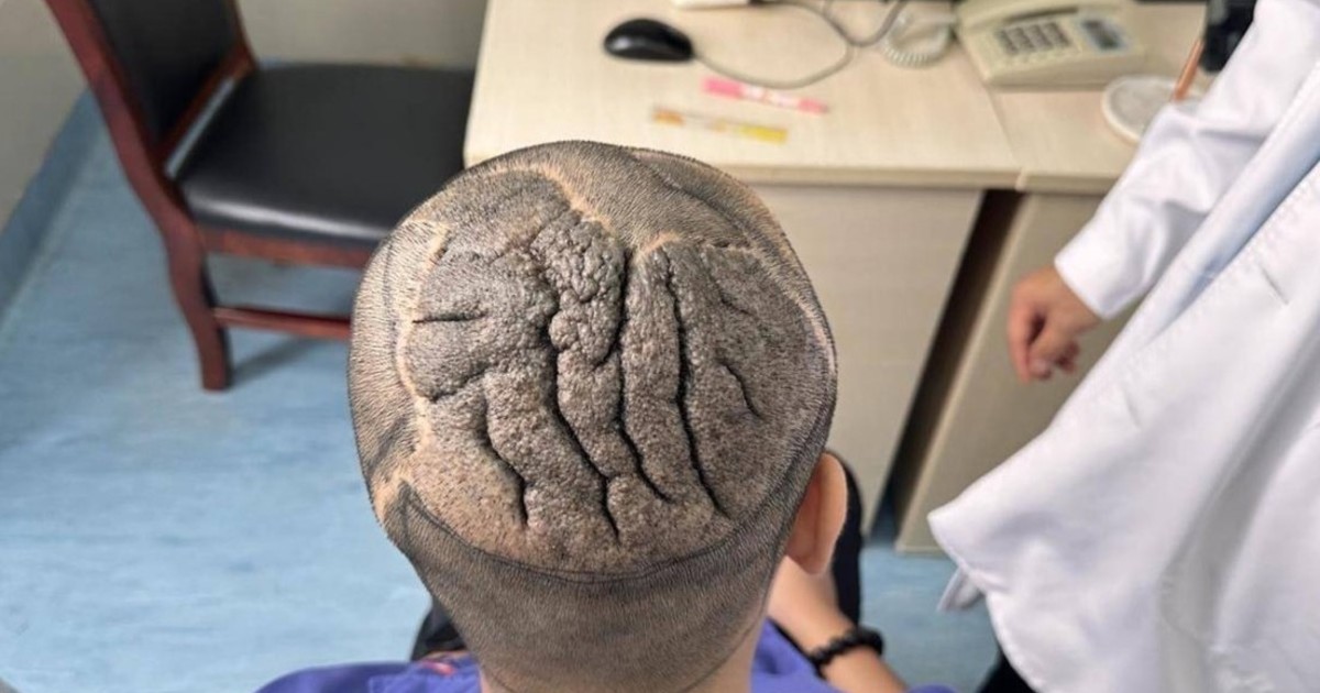 Rara afección transforma su cuero cabelludo en tejido cerebral